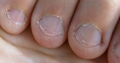 bitten nail fingers