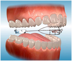 When to See Your Dentist About a Thumb Sucking Appliance - Stop Thumb